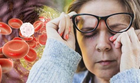 High cholesterol: Blue rings in eyes, hollenhorst plaque or droopy ...