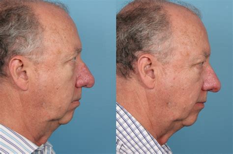 Before and After - Rhinophyma |Dr. Sidle