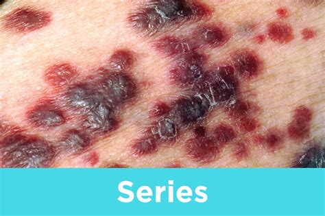 HIV 2: prevention, symptoms, diagnosis and contact tracing | Nursing Times