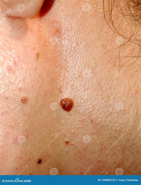 A Birthmark Or A Mole On A Woman Skin Stock Photography | CartoonDealer