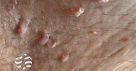 Skin tag image