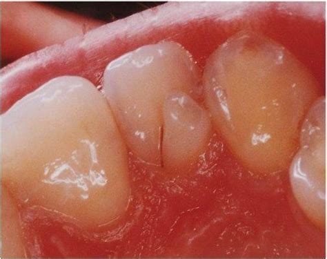 Dens invaginatus a.k.a Dens in dente | Supernumerary Teeth - Hyperdontia