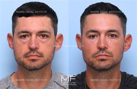 Looksmaxxing Tips: How To Get Rid of Bags Under the Eyes for Men