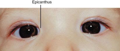 epicanthus