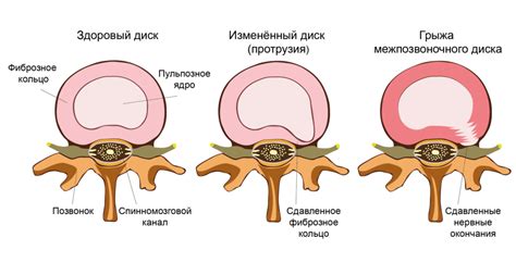 Грыжа позвоночника: симптомы, причины, диагностика и эффективное ...