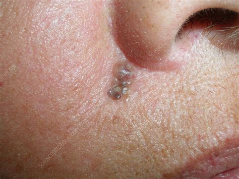Nodular basal cell carcinoma - Stock Image - C056/2576 - Science Photo ...