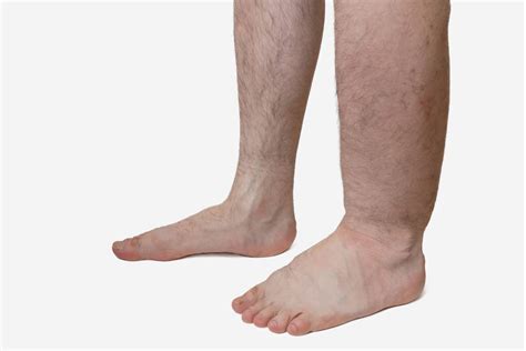 Edem - zašto, kada, kako, gdje? | vasezdravlje.com