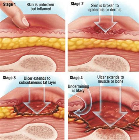 Pressure Ulcer
