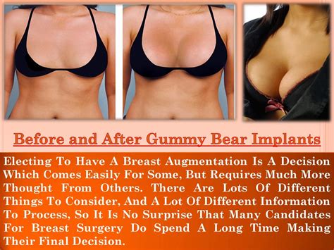 Do Breast Implants Get Bigger As They Heal at John Halliburton blog