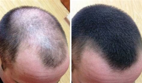Minoxidil Kirkland для роста волос и бороды: отзывы, обзор, цена, как ...