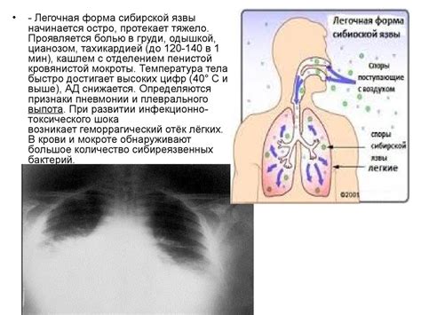 Сибирская язва - презентация онлайн