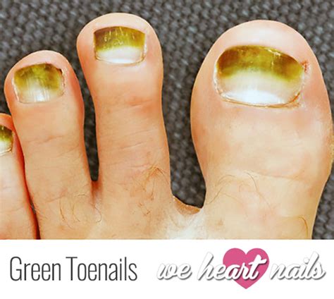 Green Toenails at Phyllis Lange blog