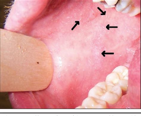 Figure 1 from Koplik spots in early measles | Semantic Scholar