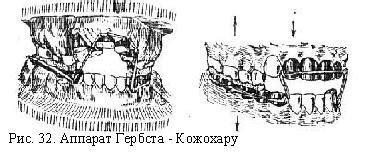 Аппарат Гербста – Кожохару.