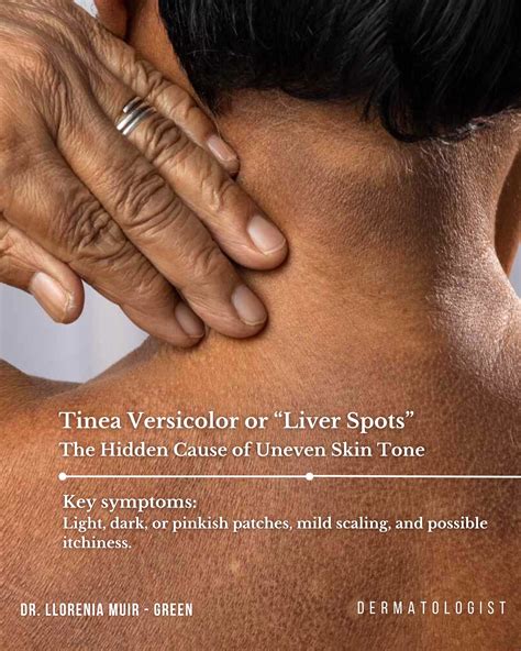 Dr. - What is it? Tinea Versicolor is a common fungal infection caused