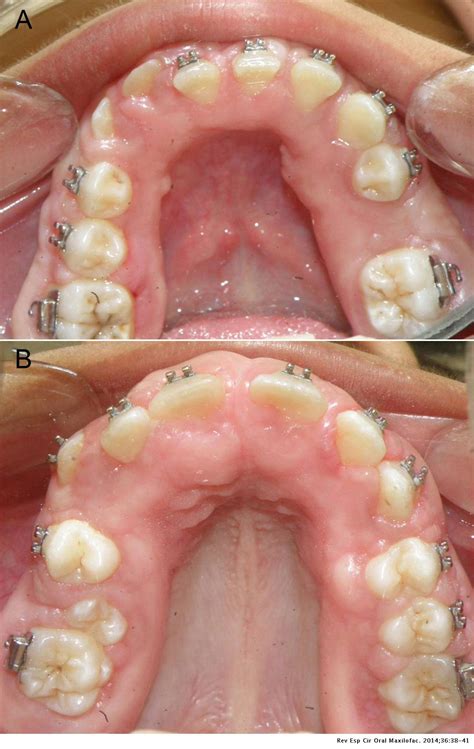 Fibromatosis gingival hereditaria: reporte de caso en un niño | Revista
