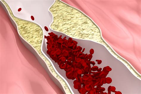 What Is Carotid Stenosis? - Vascular Specialists of Central Florida