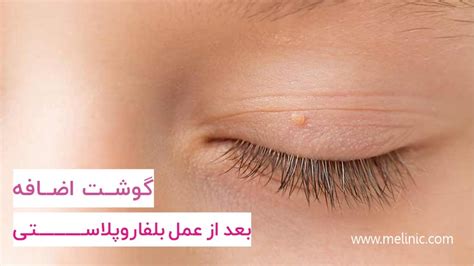 gosht adafh baad az blfaroplasty pyshgyry  drman mlynyk