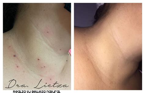 Crioterapia Verruga Antes E Depois - Crioterapia para eliminar verrugas - Dra Lietza - Salud y Belleza