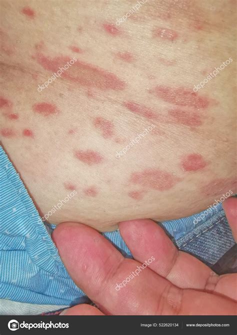 Pityriasis Rosea Skin Disease Assumed May Caused Virus Which Cannot ...