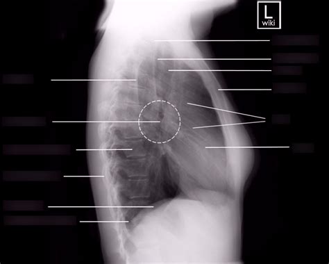 LAT Chest X-Ray Anatomy Diagram | Quizlet