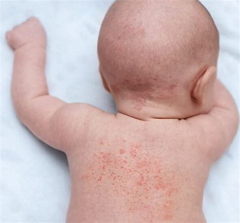 Alergia Ao Suor Em Bebe - Brotoejas x alergia ao suor: conheça a diferença - Noeh