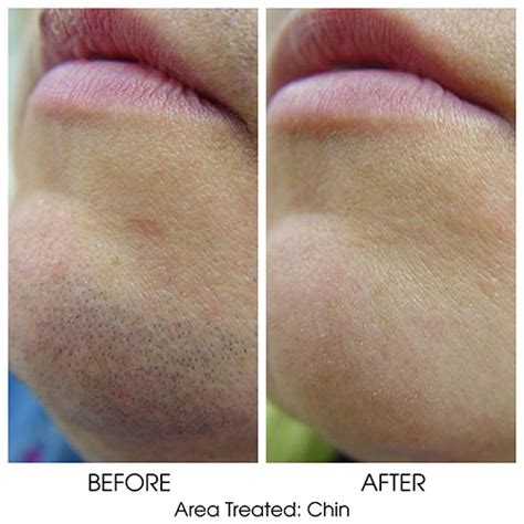 Laser Hair Removal | Lebo Skin Care