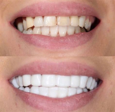 snap  veneers    noel northern blog