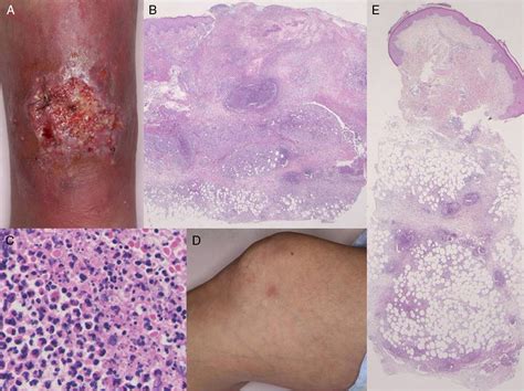 Concomitant Pyoderma Gangrenosum and Erythema Nodosum in a Patient With ...