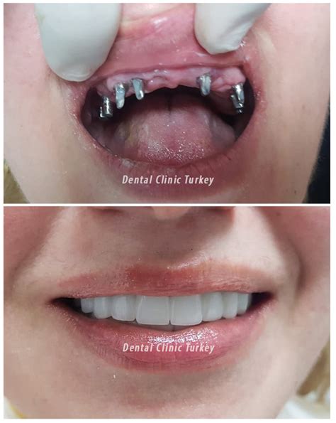 All on Six Implant - All On 6 Dental Implants | Dental Clinic Turkey