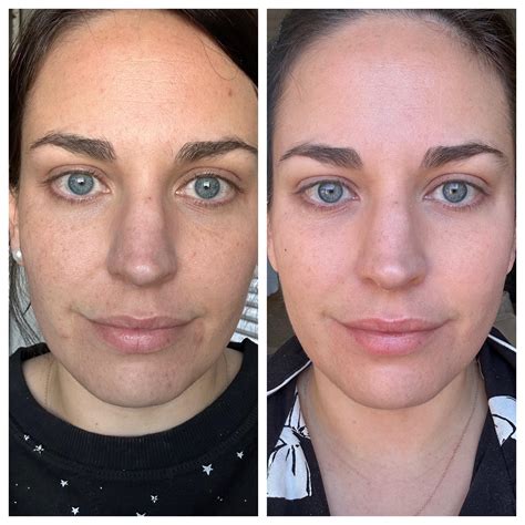 3637 best r/tretinoin images on Pholder | One year on tretinoin
