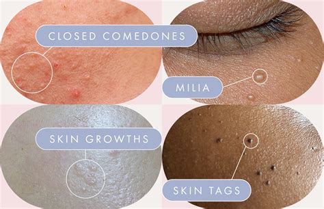 Why Is My Face So Bumpy And Itchy - Printable Templates Protal