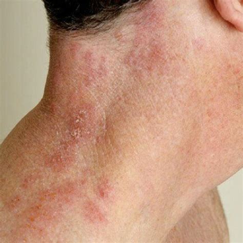 What Does Shingles Look Like? Pictues of Shingles Sympotms on Body Parts