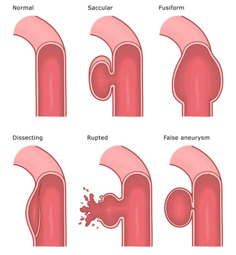 guide  fusiform brain aneurysms supreme vascular