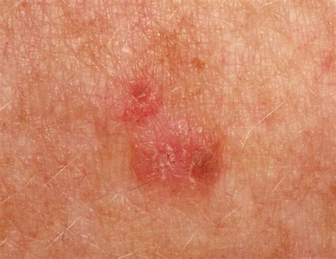 What Are Skin Keratosis at Shawna Baker blog