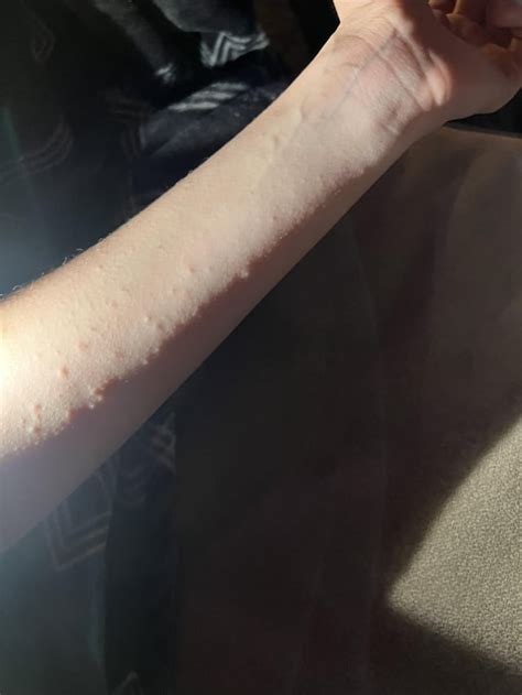 Recurrent rash on both arms? : r/DermatologyQuestions