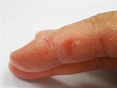 dyshidrotic eczema fingers understanding dyshidrotic eczema