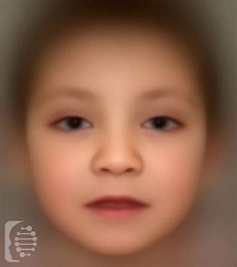 fdna kabuki syndrome key symptoms   diagnosis