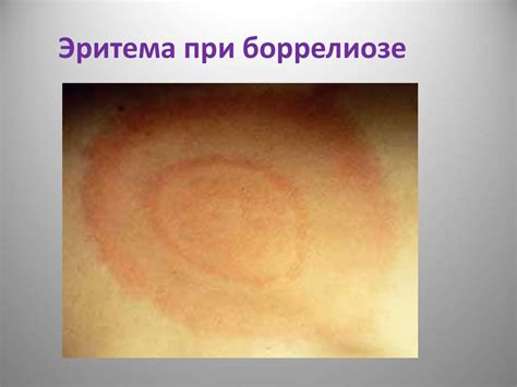 Патогенные спирохеты сем. Spirochaetaceae сем. Leptospiraceae - online ...