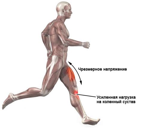Тендинит коленного сустава (воспаление сухожилий): симптомы и лечение