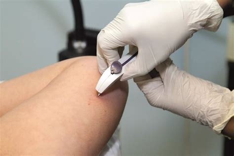 Types Of Contraceptive Implants Contraceptive Implant (Implanon) In