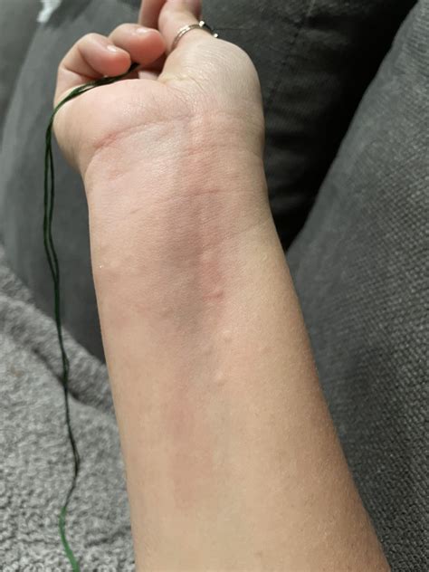 Does this look like scabies? : r/scabies