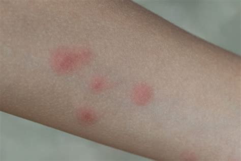 Shingles Rash Images – Browse 2,130 Stock Photos, Vectors, and Video ...