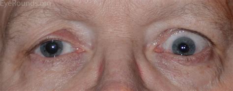 A Primer on Ptosis