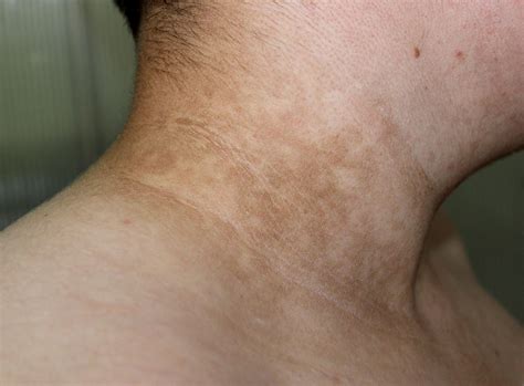 Diabetes and Skin Problems: Know About Diabetic Skin Disorder Causes ...