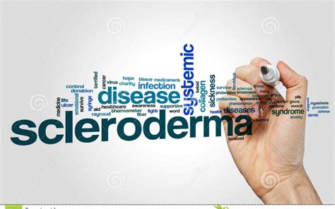 Scleroderma Treatment in Thailand - Almurshidi Medical Tourism - Best ...