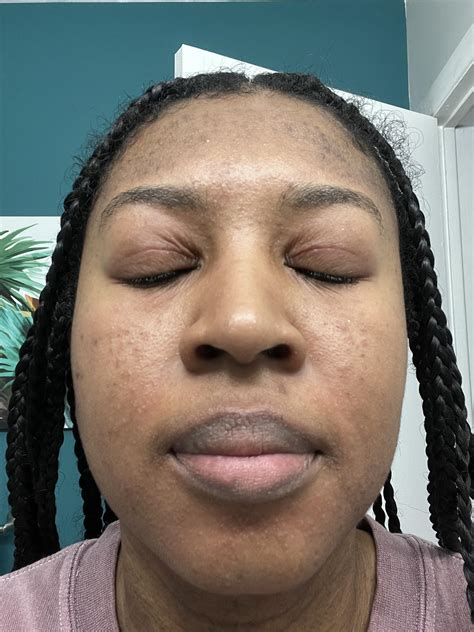 HELP! My skin is red, burning and itchy : r/SkincareAddicts