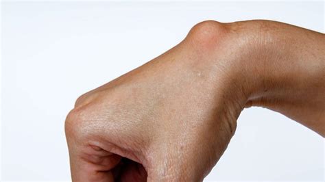 easy ganglion cyst wrist exercises  remove lump  surgery