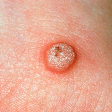 STD Symptoms Women Need to Know About — STD Symptoms in Women