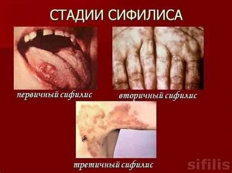 Триппер: что это такое, симптомы, первые признаки и лечение